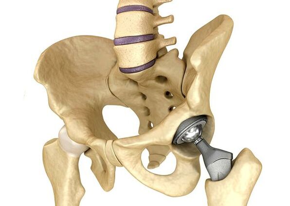 Endoprosthetics hip joint