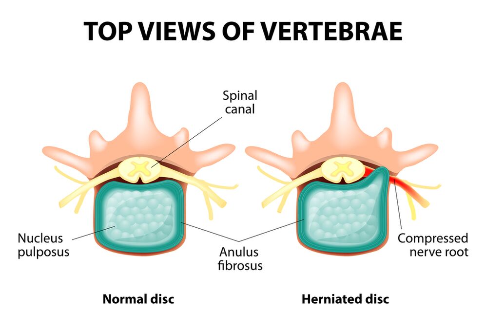 Healthy intervertebral disc and hernia