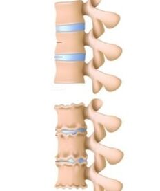 The cause of osteochondrosis