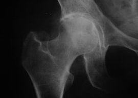 X-ray of the hip joint with arthrosis