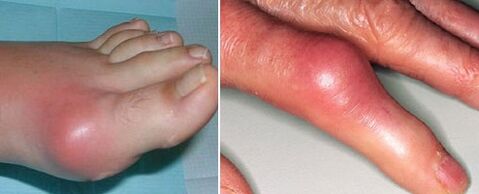 the appearance of joints with arthritis