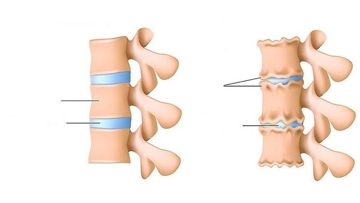 spine and healthy spine affected by osteochondrosis