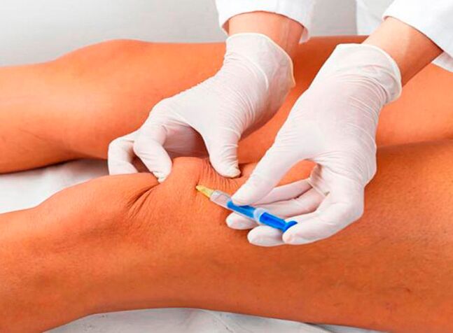 Intra-articular injection of drugs for arthrosis of the knee joint