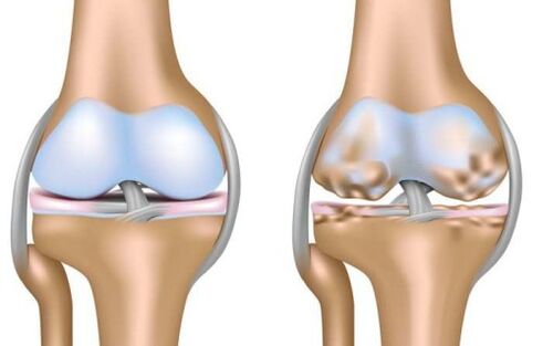 healthy joints and destruction of the knee joint in arthrosis