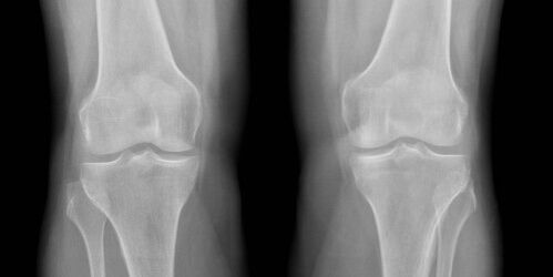 x-ray osteoarthritis of the knee