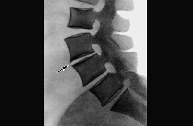 Manifestations of osteochondrosis of the thoracic spine on radiograph