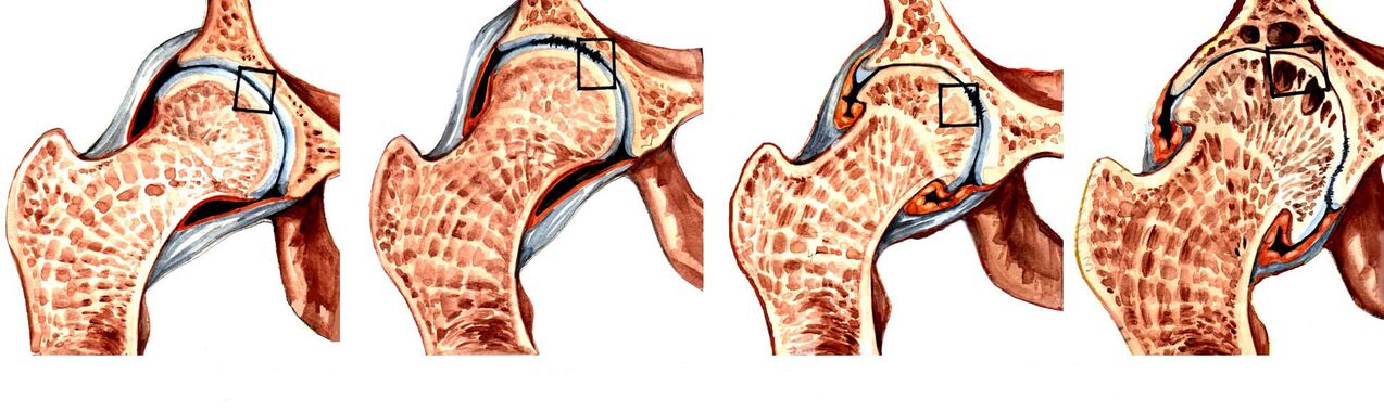 Deformation level of coxarthrosis