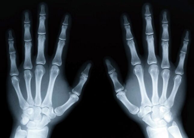 Gout triggers the development of gouty arthritis, which can be diagnosed using x-rays