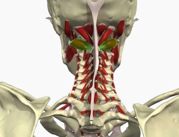 Vail arterial syndrome